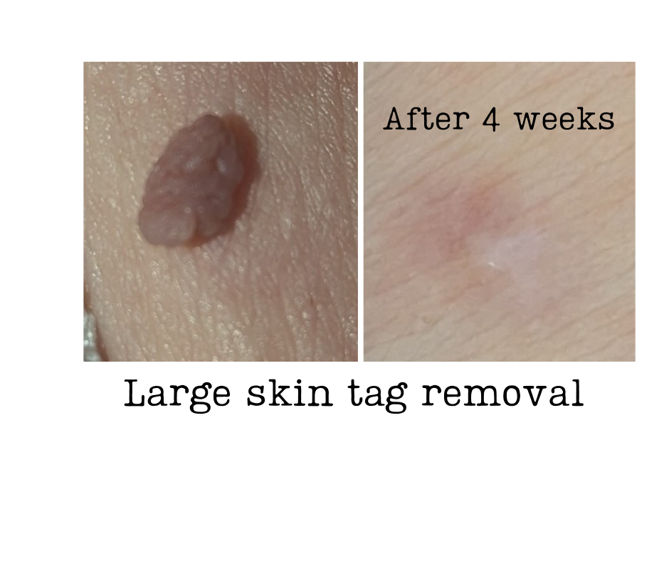 Skin tag removal - Before & After Cryo