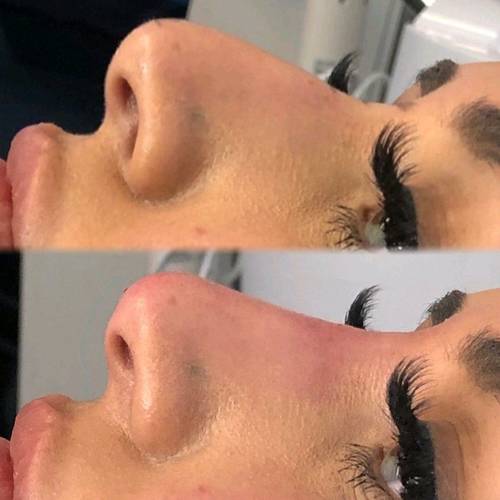 Liquid Rhinoplasty