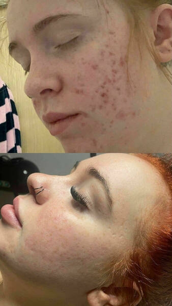 Acne results over a period of 6 months using recommended skin care alongside a course of peels/microneedling 