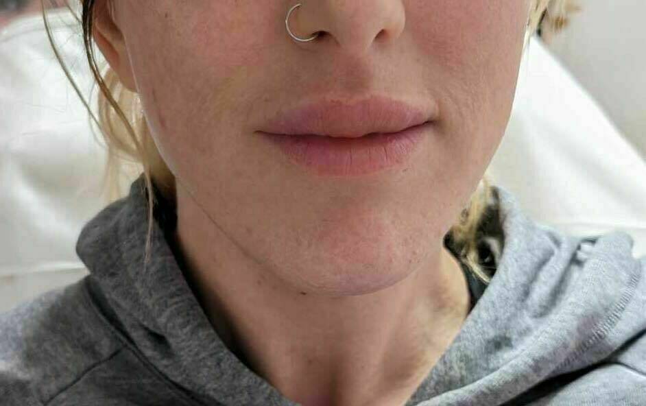 Jaw Filler