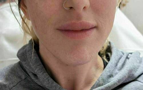 Jaw Filler