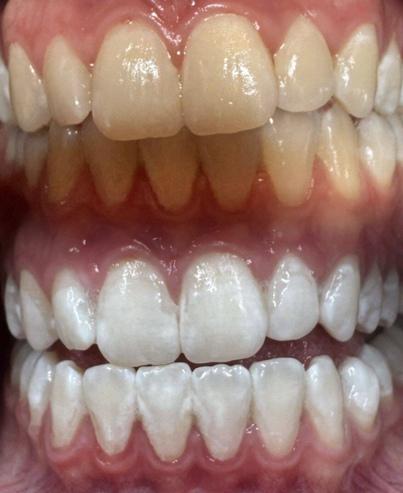 Zahnbleaching