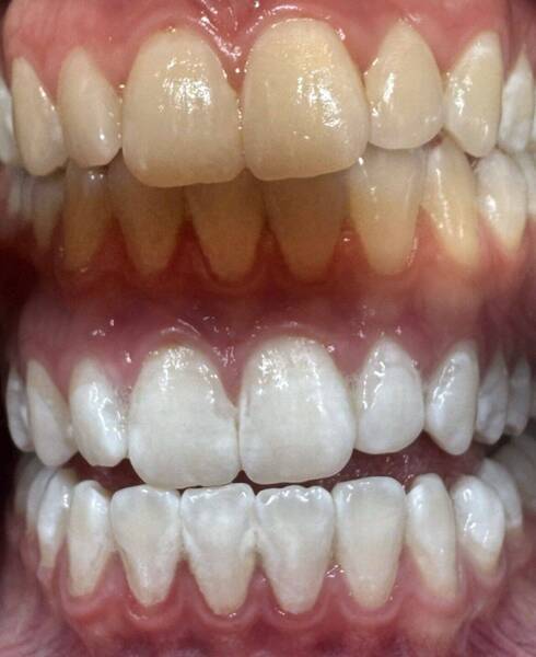 Zahnbleaching