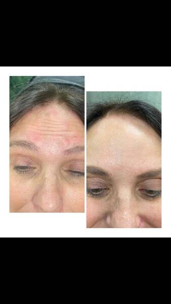 Results from anti wrinkle injections by Ellice 