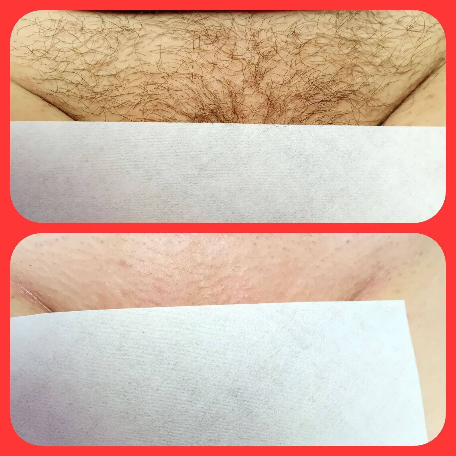 Intimate waxing 