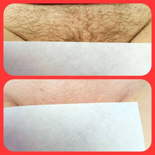 Intimate waxing 