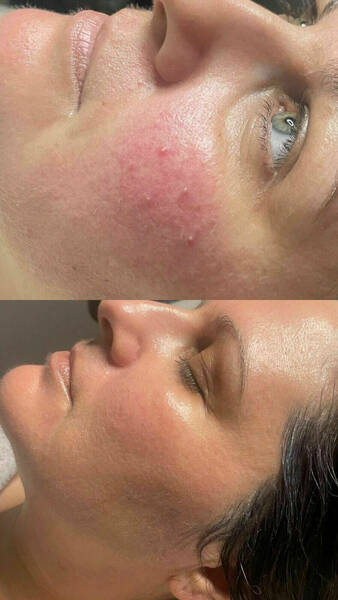 Rosacea results. These Results are from a 6 week course of Our cool peel system 