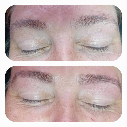 Brow reshape 