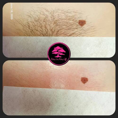 Intimate waxing 