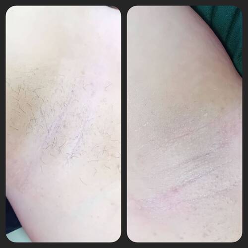 Underarm wax 