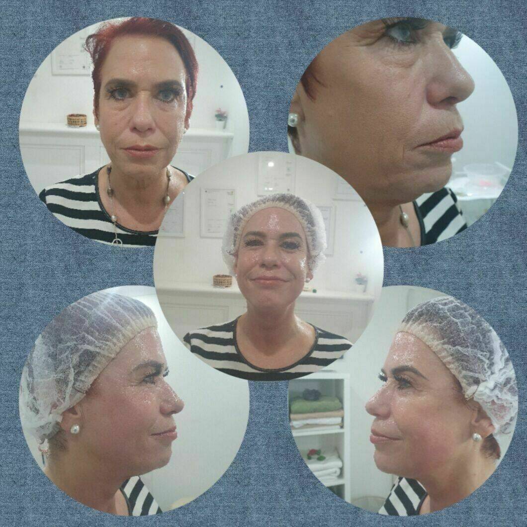 Collagen lift 