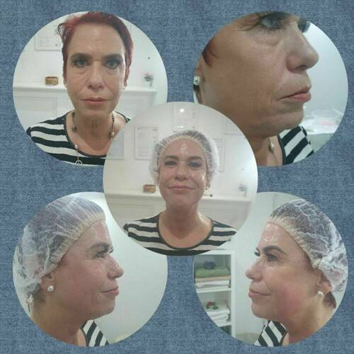 Collagen lift 