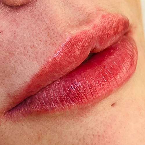Lip Filler