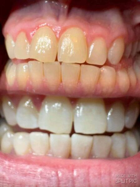 Zahnbleaching 