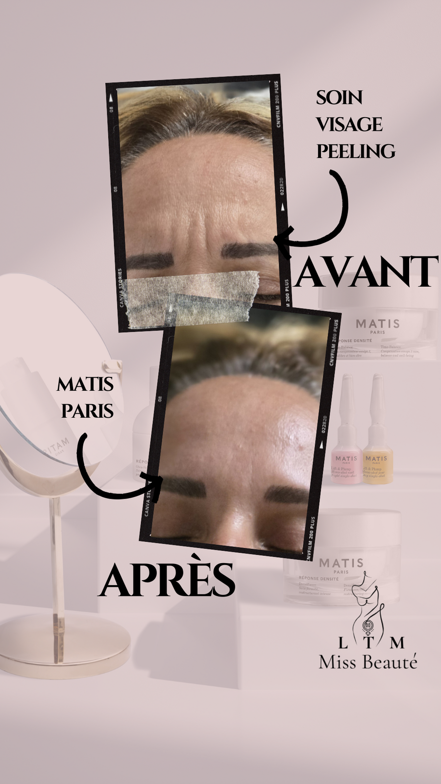 Peeling Matis