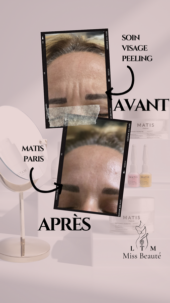 Peeling Matis