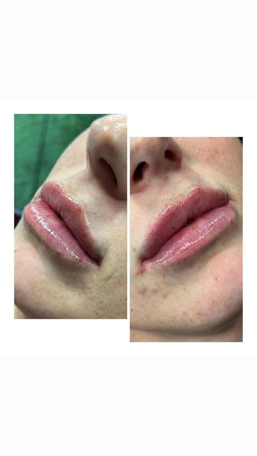 Lip filler by Ellice 