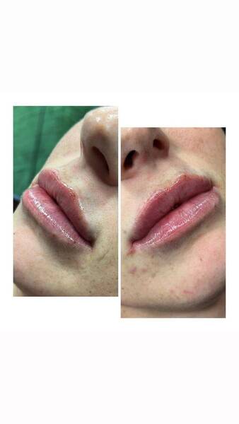 Lip filler by Ellice 