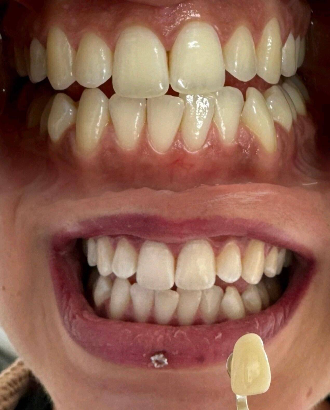 Zahnbleaching