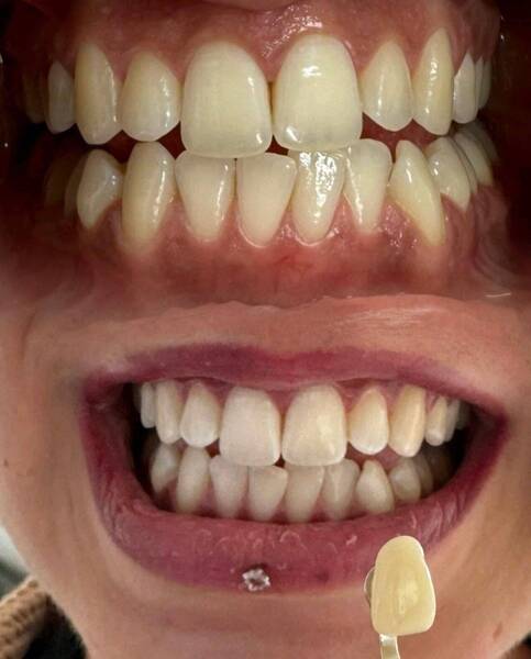 Zahnbleaching