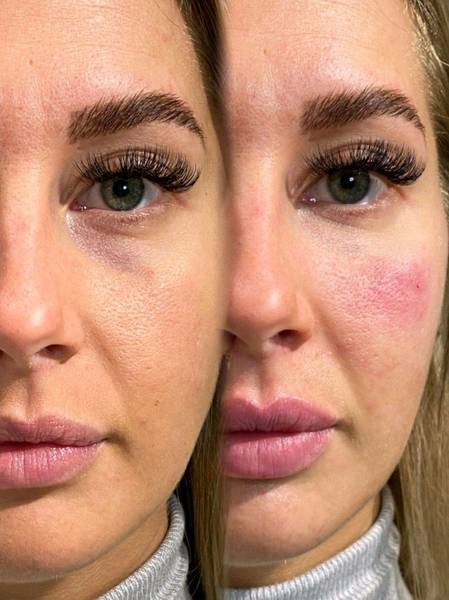 Tear trough/under eye filler