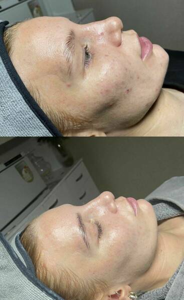 3 week results from our infamous environ cool peel system