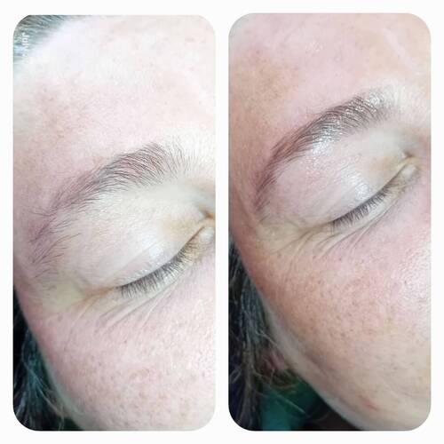 Brow reshape 