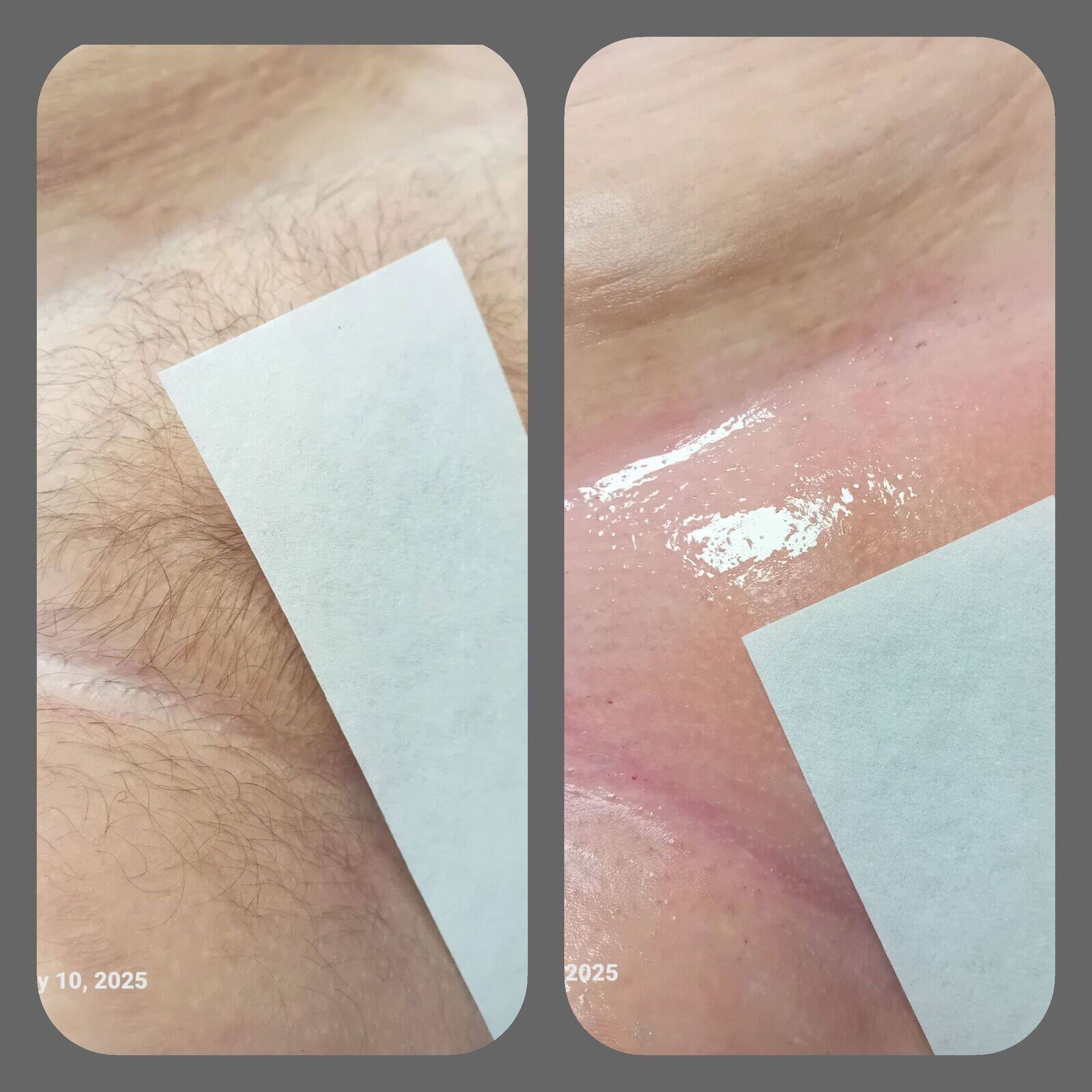 Intimate waxing 