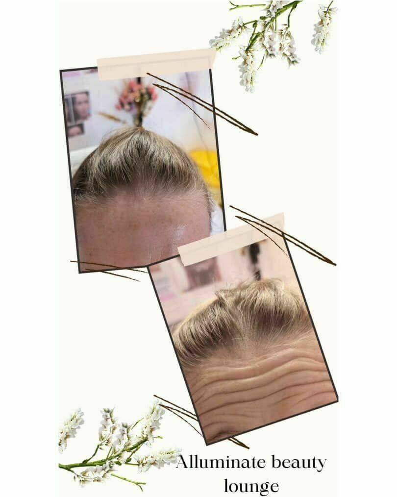 Botox 3 area