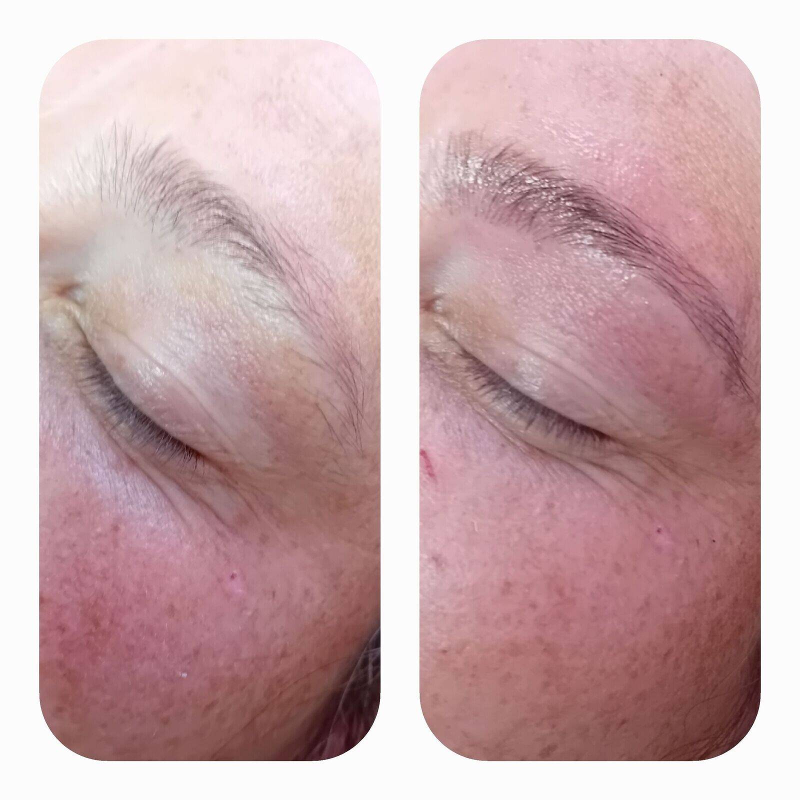 Brow reshape 