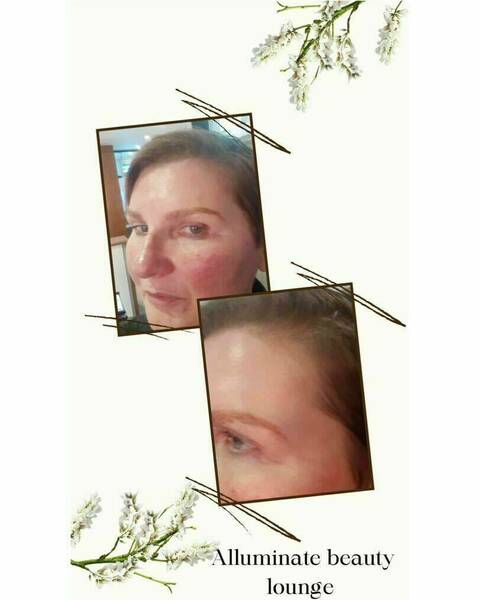 Botox 3 areas