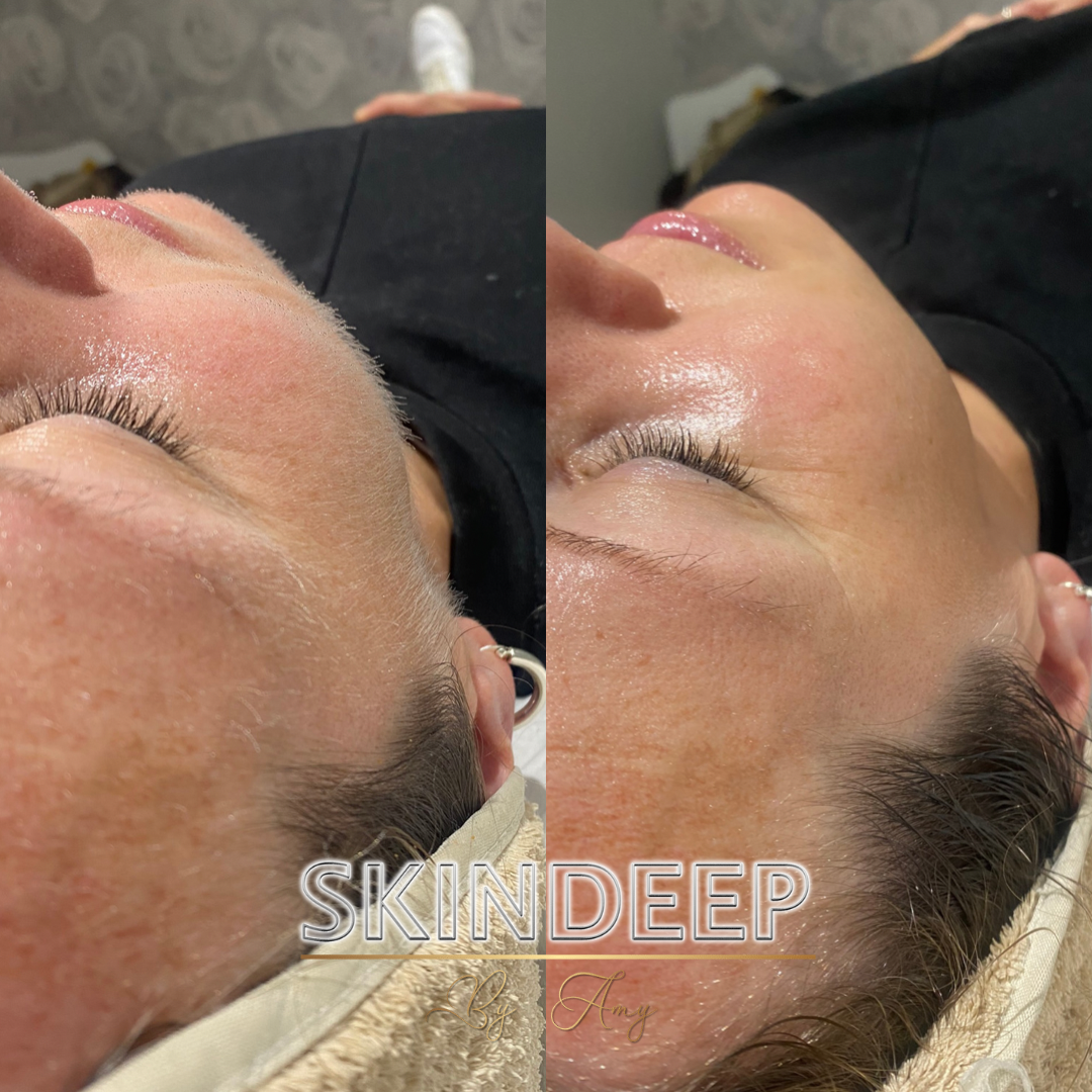 Before & After Dermaplaning - Removing peach fuzz and dead skin cells leaving a smooth complexion